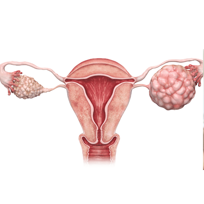 Ovarian Cyst Causes