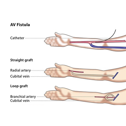 AV Fistula Treatment