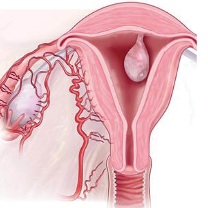 Uterine Fibroids causes