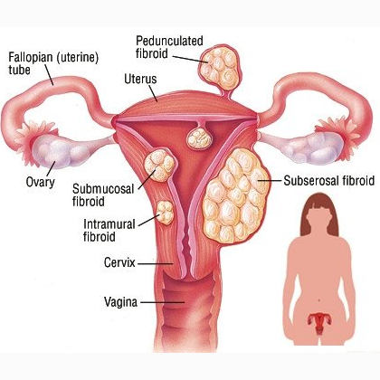 Uterine fibroids Severe Symptoms 